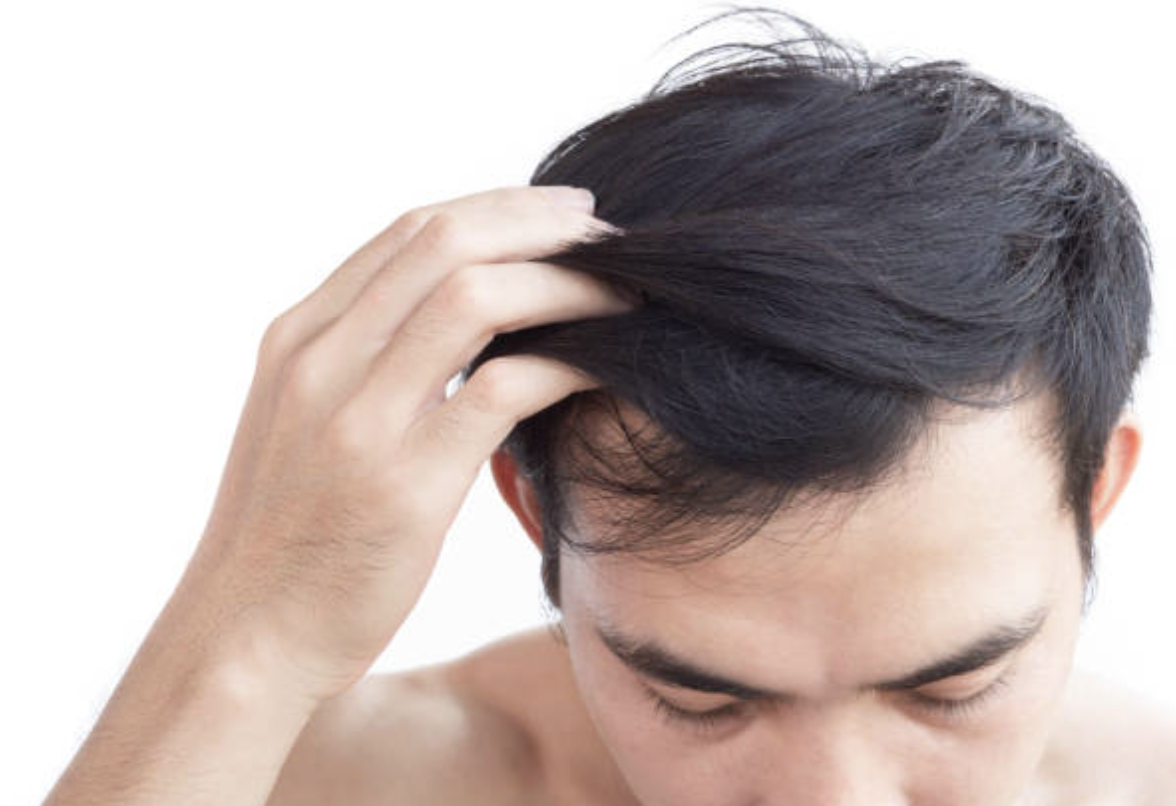 頭髮掉不停？揭開脫髮元兇